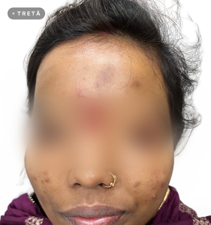 Chemical peel before treatment