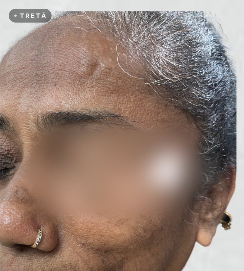 Dermatosis papulosa nigra after treatment at TRETĀ Derma