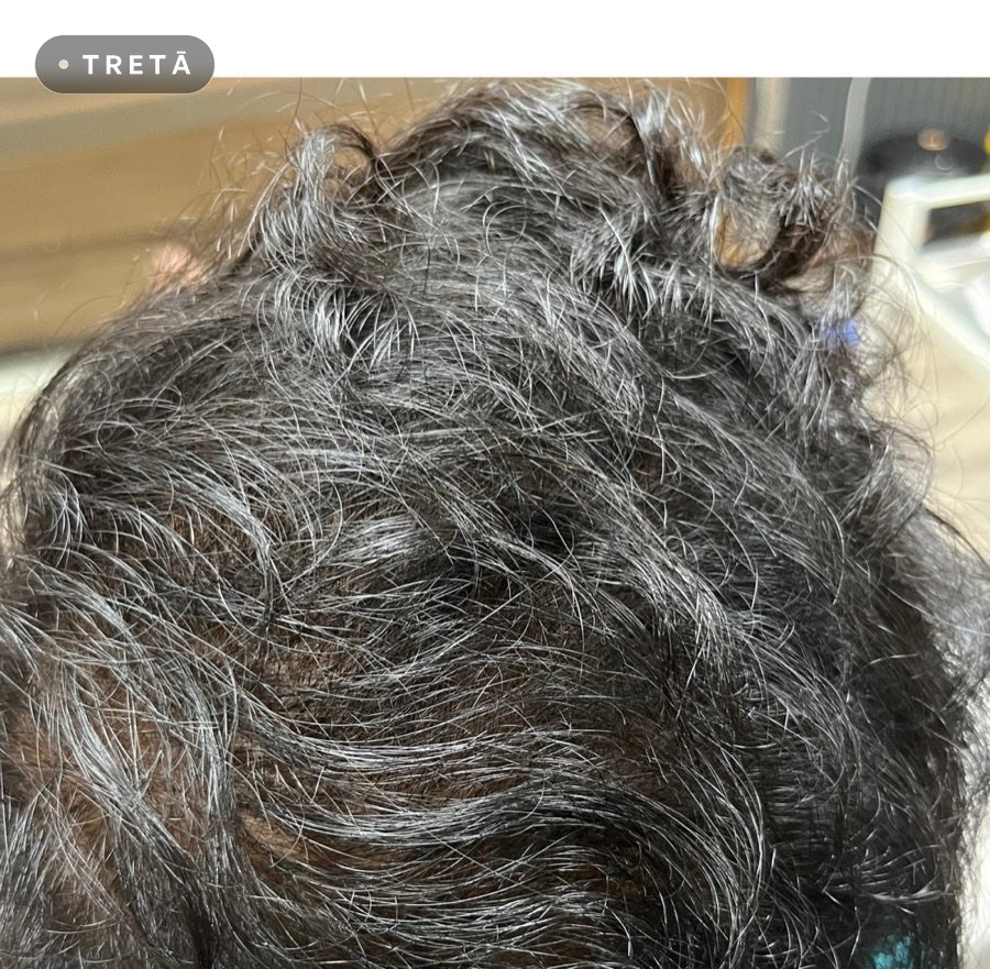 Hair loss with GFC after treatment at TRETĀ Derma