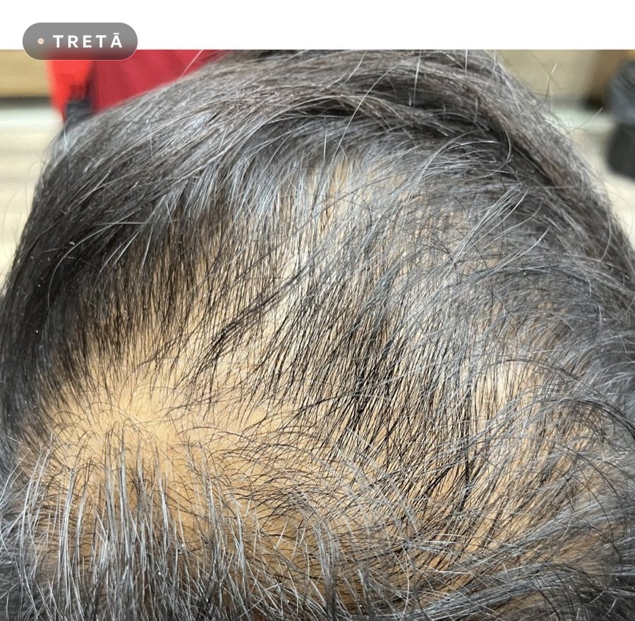 Hair loss with GFC before treatment