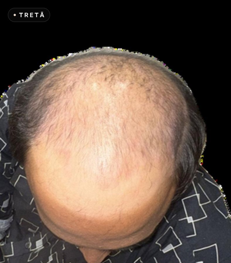 Hair transplant, crown before treatment