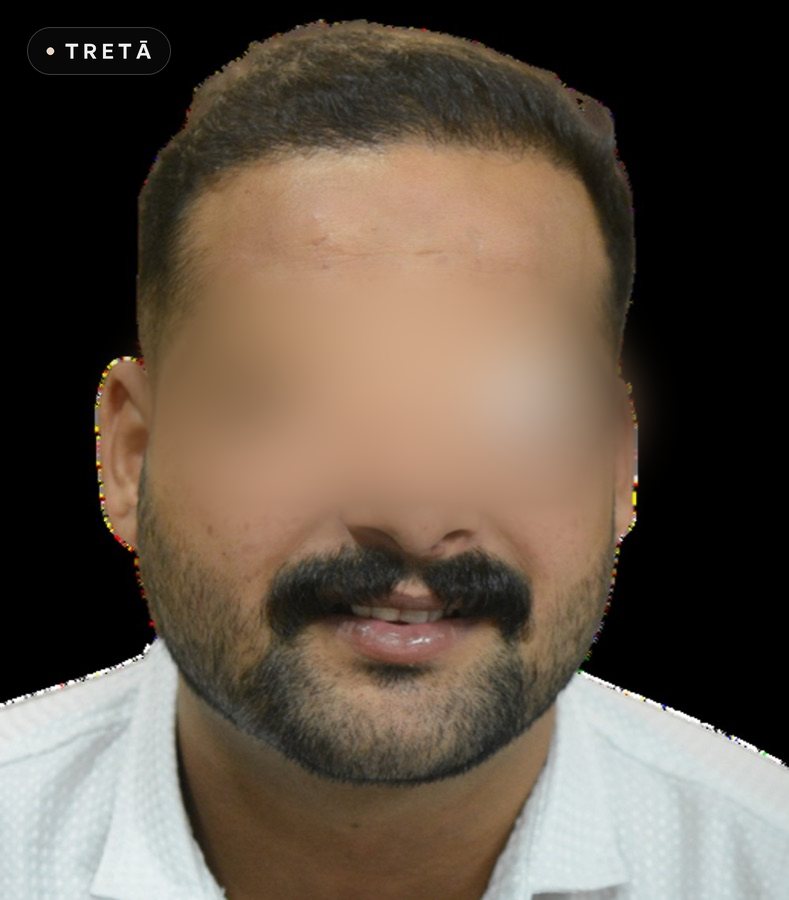 Hair transplant, hairline after treatment at TRETĀ Derma