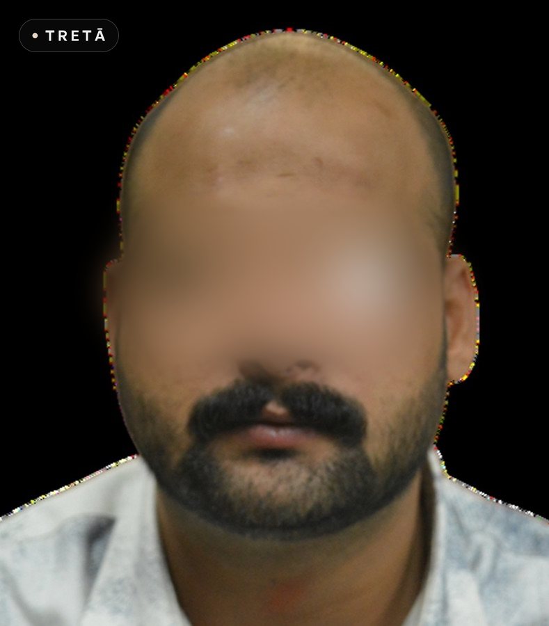 Hair transplant, hairline before treatment
