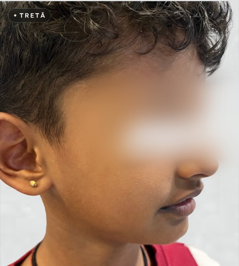 Pityriasis alba after treatment at TRETĀ Derma