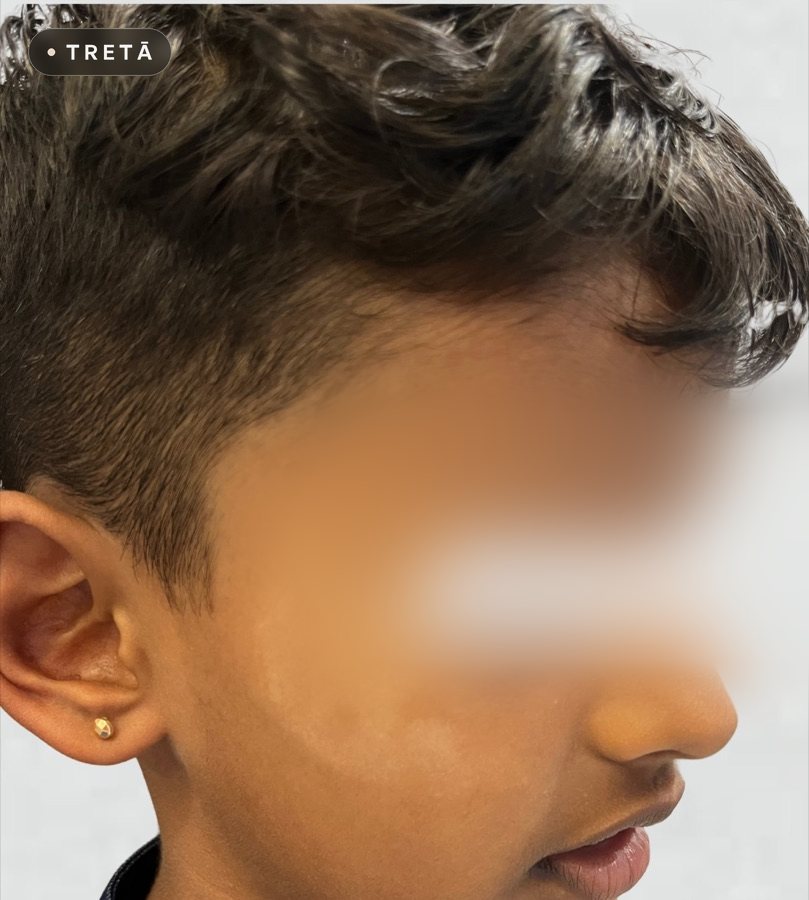 Pityriasis alba before treatment