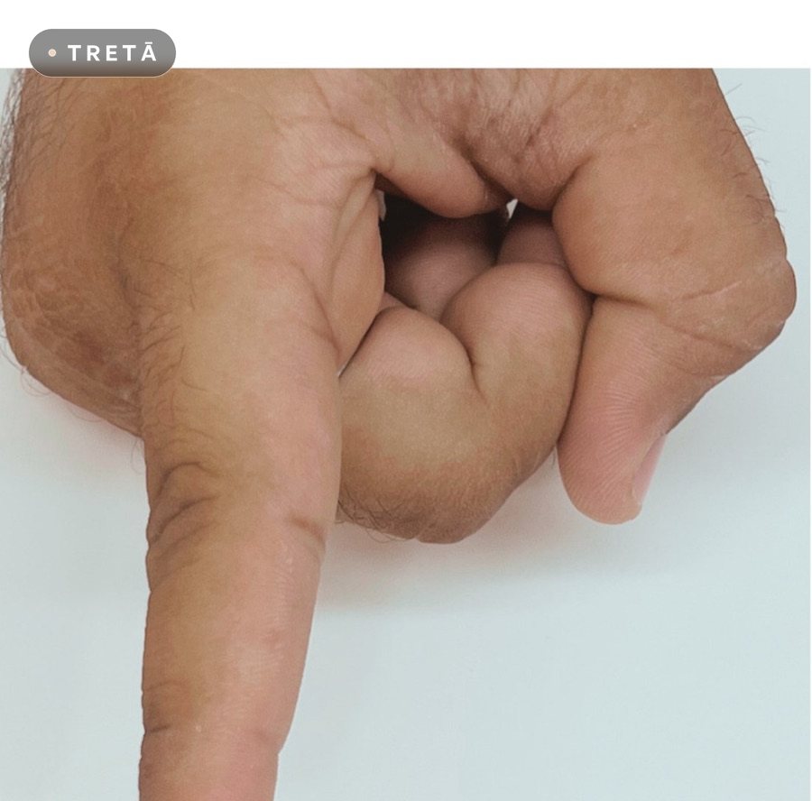 Warts after treatment at TRETĀ Derma