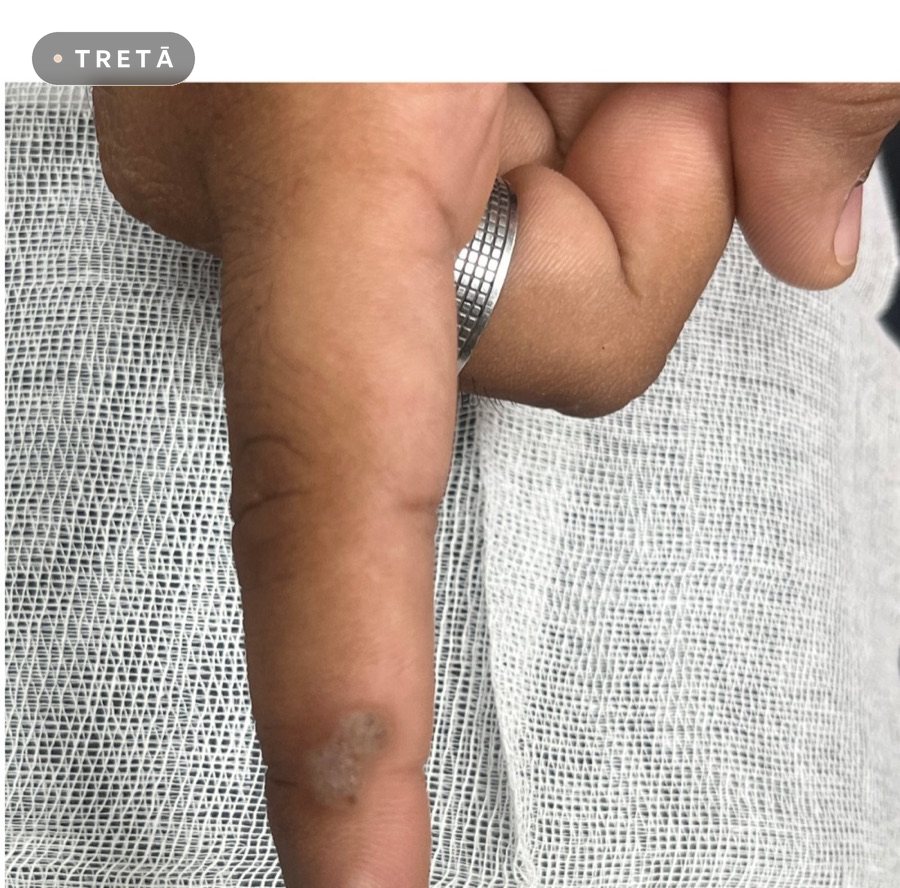 Warts before treatment